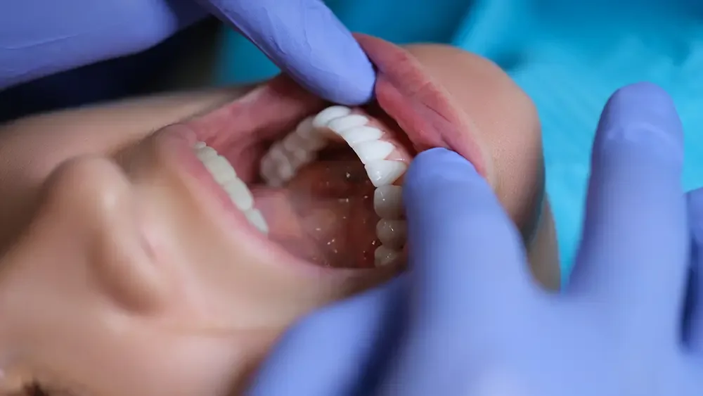 Benefits of Dental Veneers