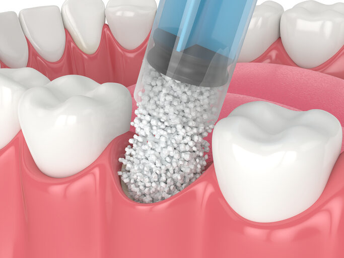 Why is it Necessary to Extract a Wisdom Tooth?