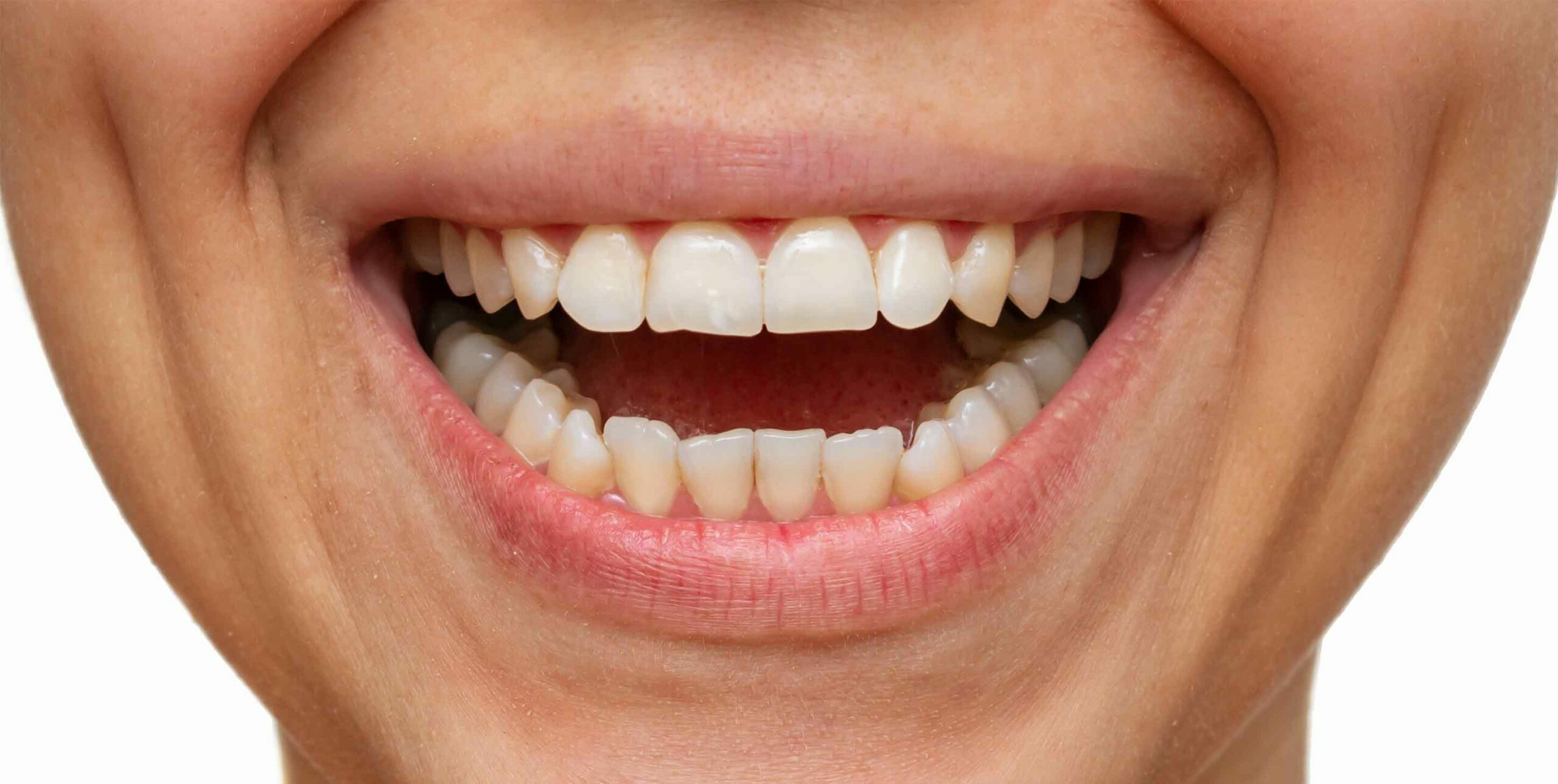 Bad Teeth