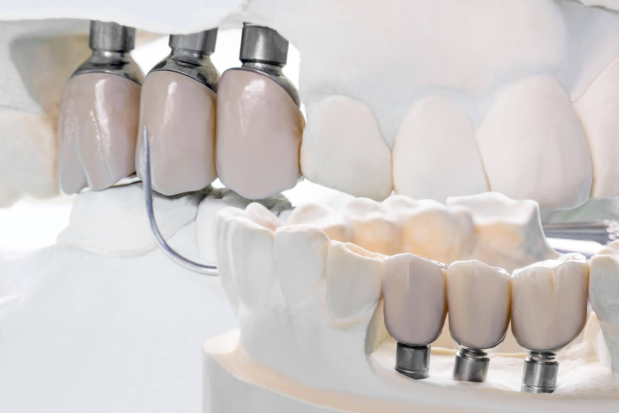 Dental Bridges At Muldoon Dental Arts