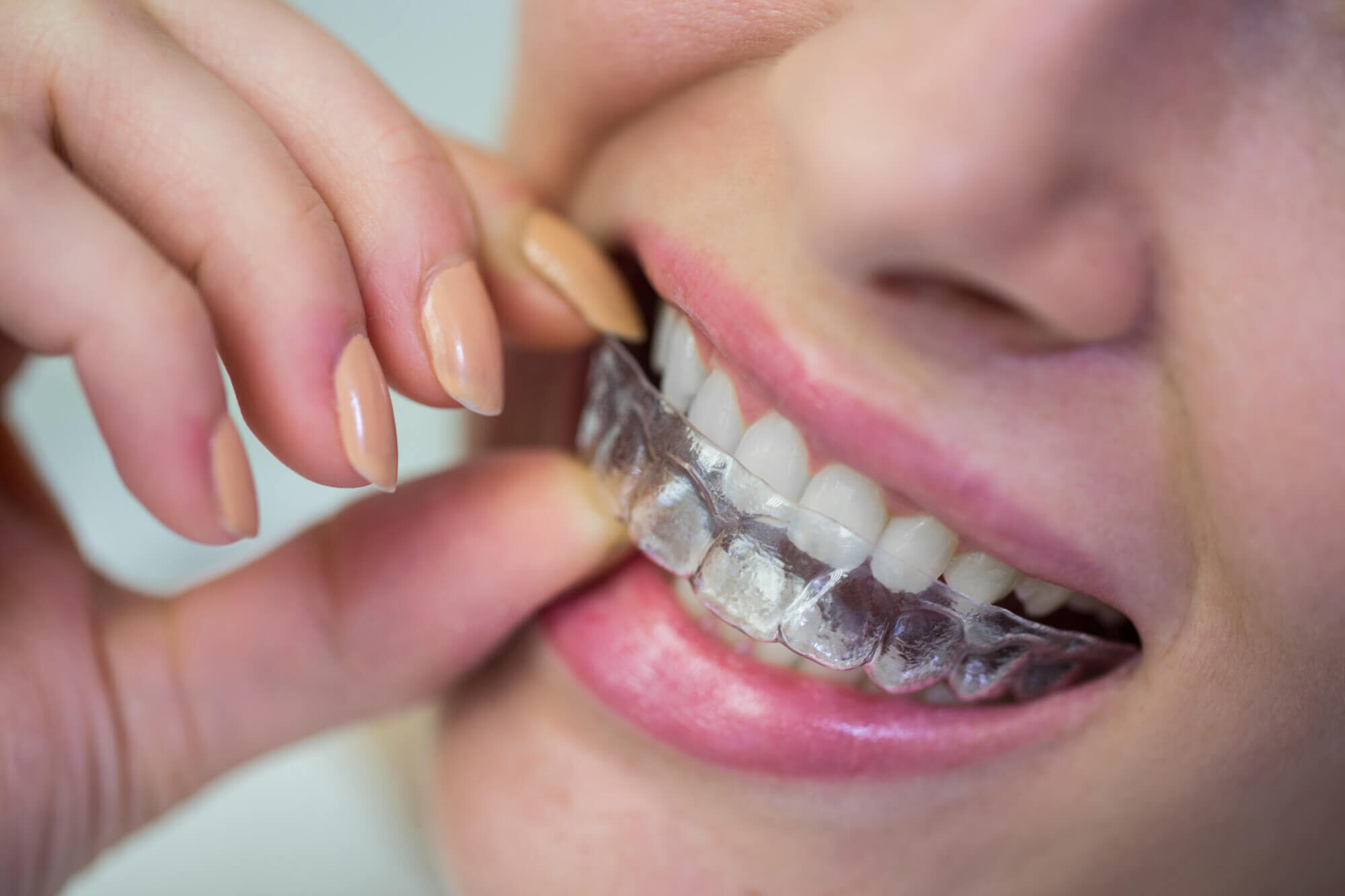 Invisalign in Anchorage, AK